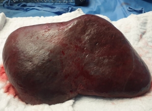 نجاح استئصال طحال متضخم  بحجم‏١٥x٣٠ سم لمريضة في مستشفى الملك فيصل بمكة